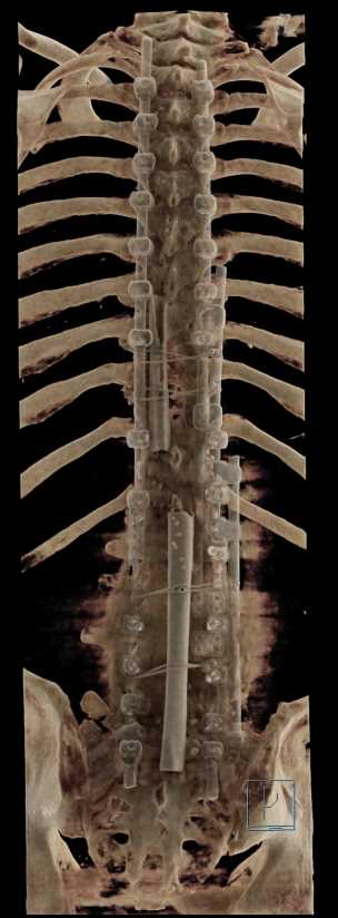 Marked Osteopenia Spine with Hardware in Place - CTisus CT Scan