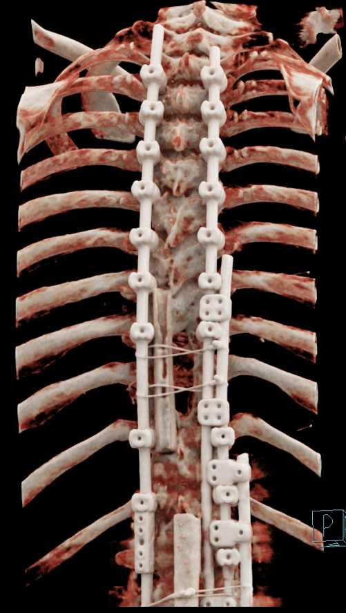 Marked Osteopenia Spine with Hardware in Place - CTisus CT Scan