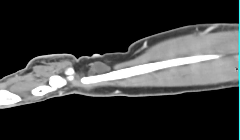 Neurofibroma Near Wrist - CTisus CT Scan