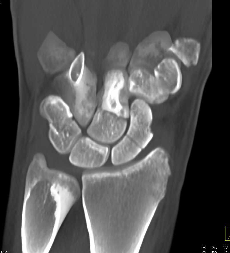 Multiple Carpal Fractures Including Scaphoid - CTisus CT Scan