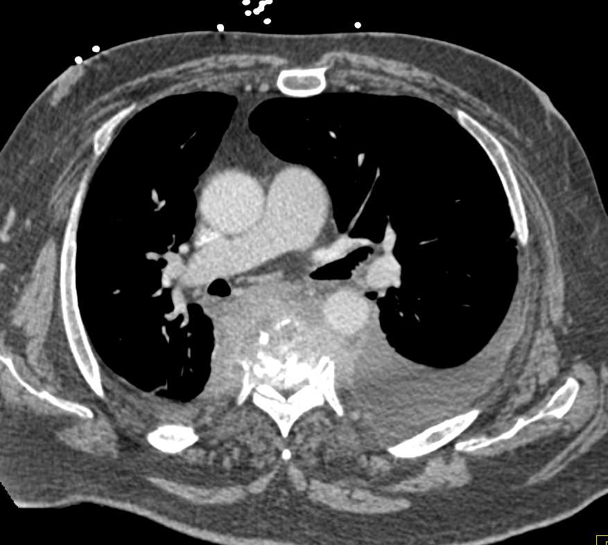 Osteomyelitis Spine with Paraspinal Abscess - CTisus CT Scan
