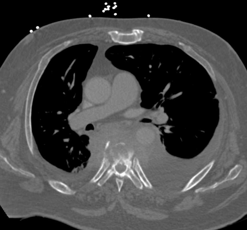 Osteomyelitis and Paraspinal Abscess T-Spine - CTisus CT Scan
