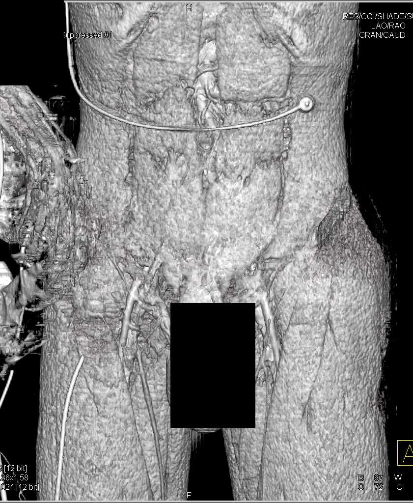 Rhabdomyolitis Left Pelvis Post Trauma - CTisus CT Scan