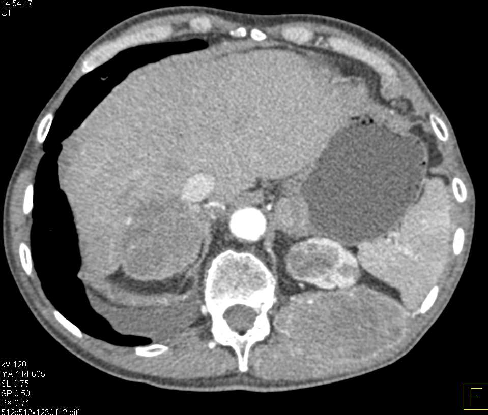 Metastatic Sarcoma to Lung, Liver and Adrenal Glands - CTisus CT Scan