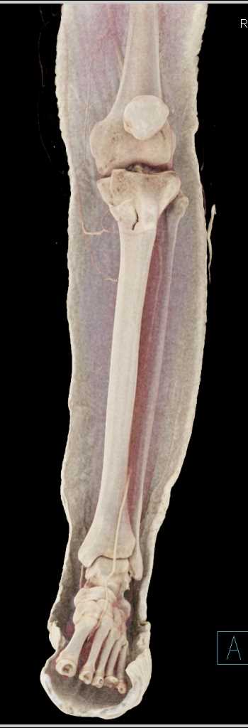 Tibial Plateau Fracture - CTisus CT Scan