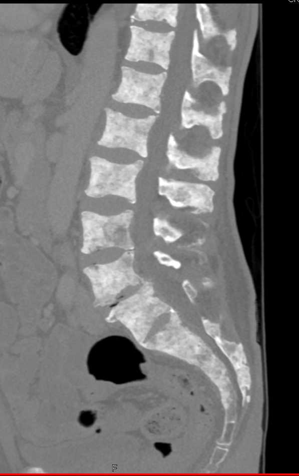 Renal Osteodystrophy - CTisus CT Scan