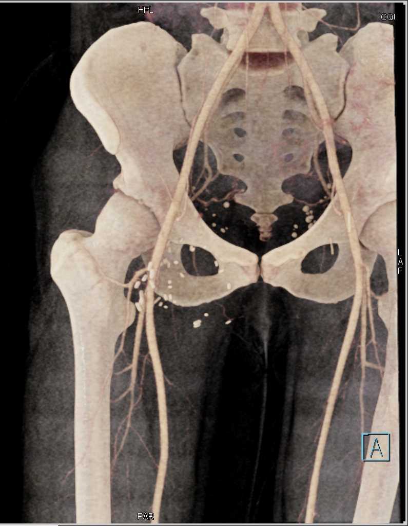 Induration Right Groin from IVDA - CTisus CT Scan