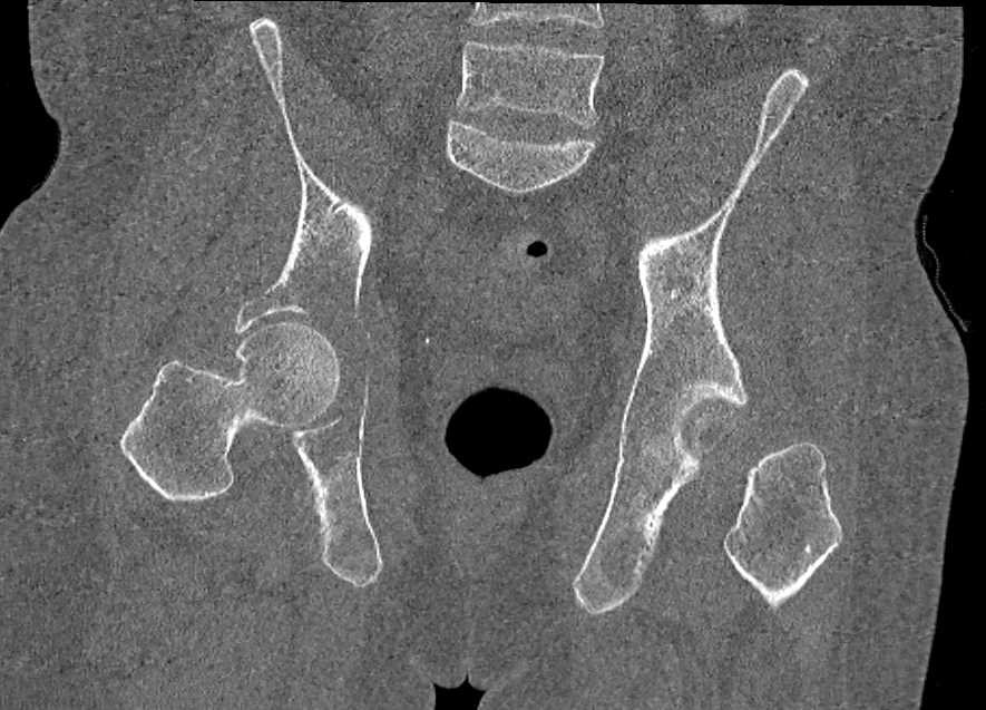 Ewings Sarcoma - CTisus CT Scan