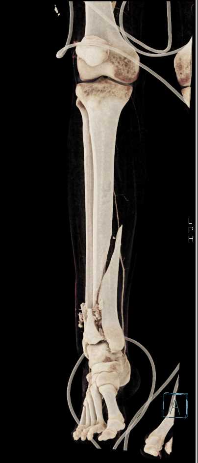 Spiral Fracture Tibia and fibula - CTisus CT Scan