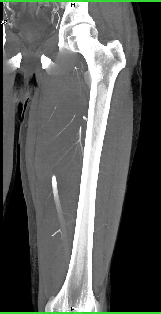 Thigh Hematoma - CTisus CT Scan