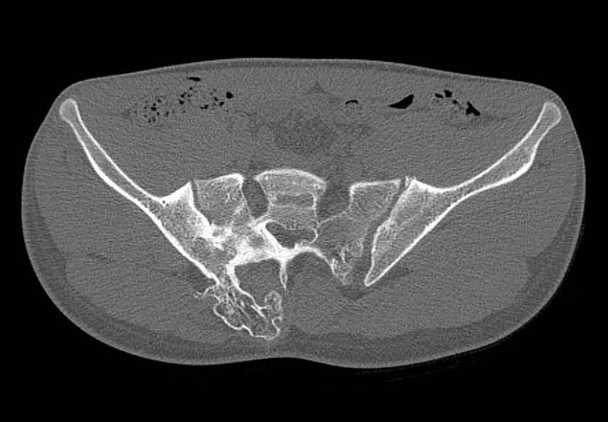 Hereditary Multiple Exostoses - CTisus CT Scan