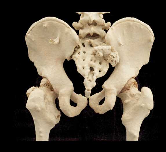 Hereditary Multiple Exostoses - CTisus CT Scan