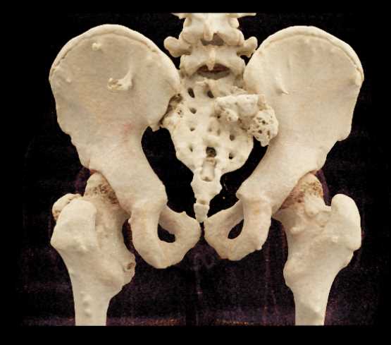 Hereditary Multiple Exostoses - CTisus CT Scan