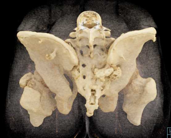 Hereditary Multiple Exostoses - CTisus CT Scan