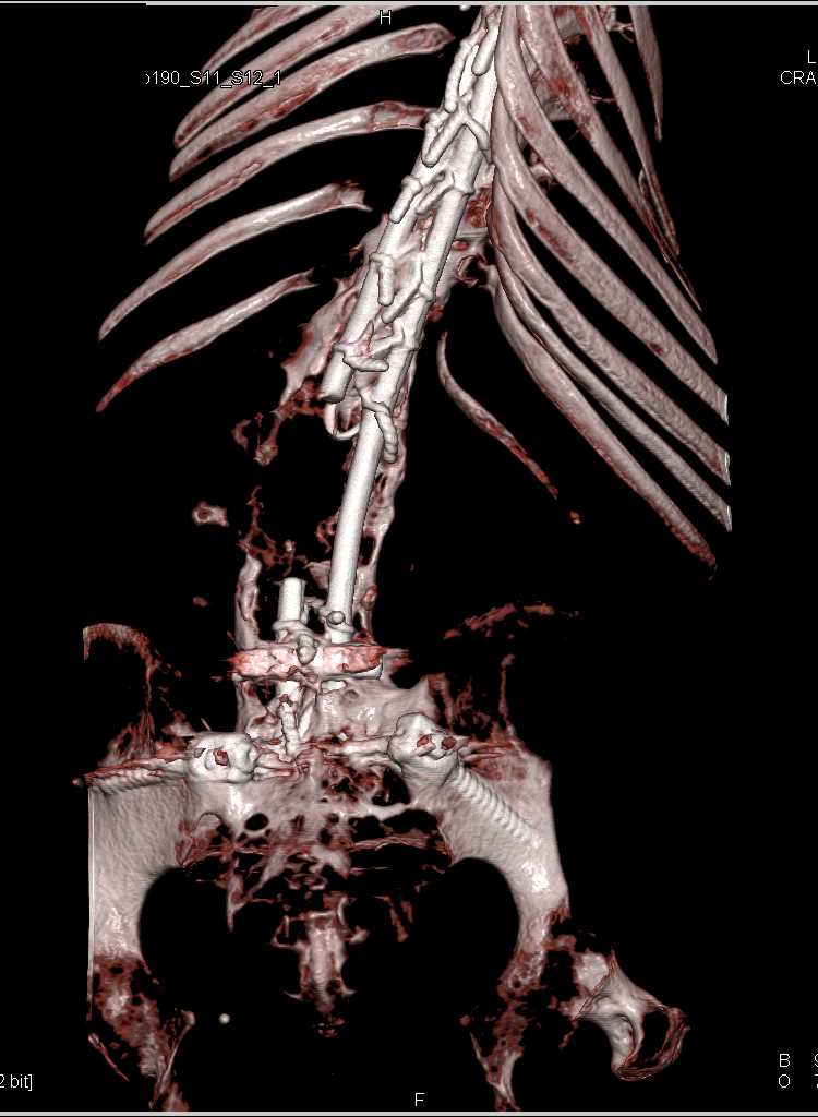 Spinal Hardware in Place - CTisus CT Scan