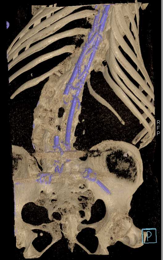 Spinal Hardware in Place - CTisus CT Scan