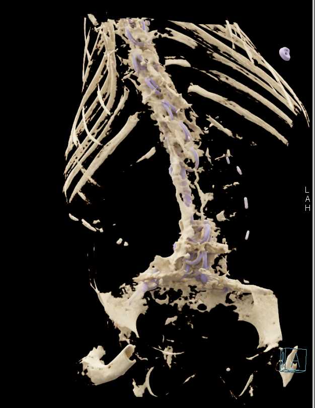 Spinal Hardware in Place - CTisus CT Scan