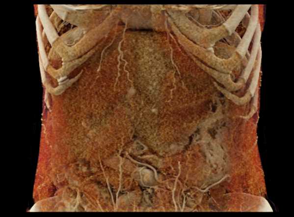 Cinematic Rendering of the Chest Wall - CTisus CT Scan