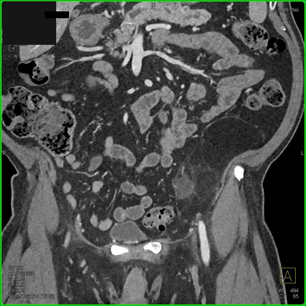 Liposarcoma Left Flank - CTisus CT Scan