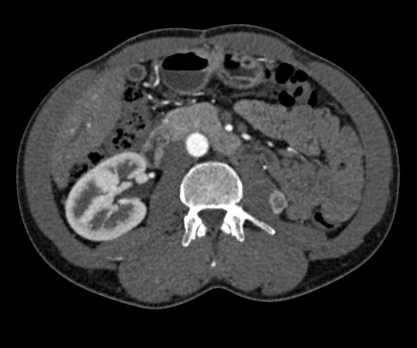 Metastatic Renal Cell Carcinoma to the Left Psoas Muscle - CTisus CT Scan