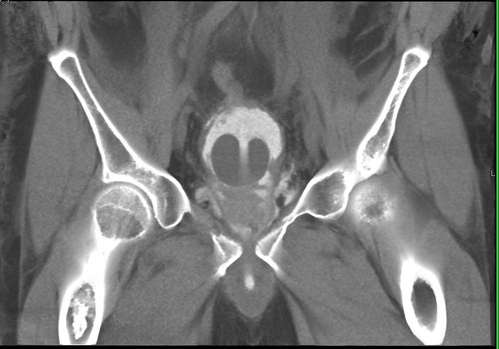 Necrotizing Fasciitis - CTisus CT Scan