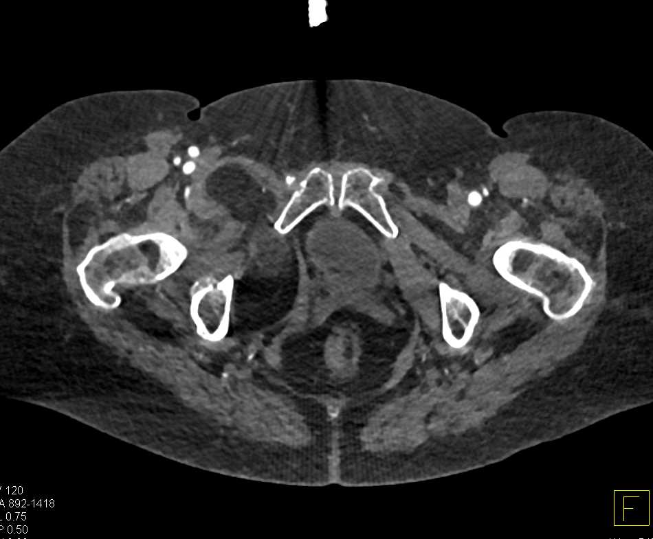 Lipoma Upper Right Thigh - CTisus CT Scan