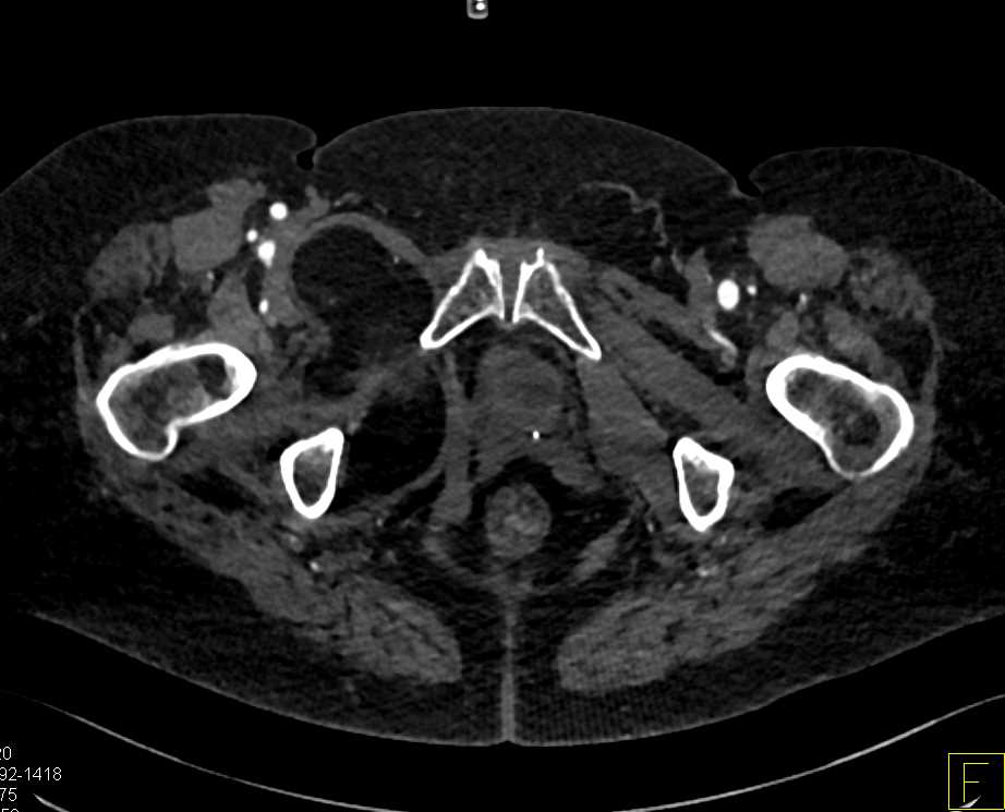 Lipoma Upper Right Thigh - CTisus CT Scan
