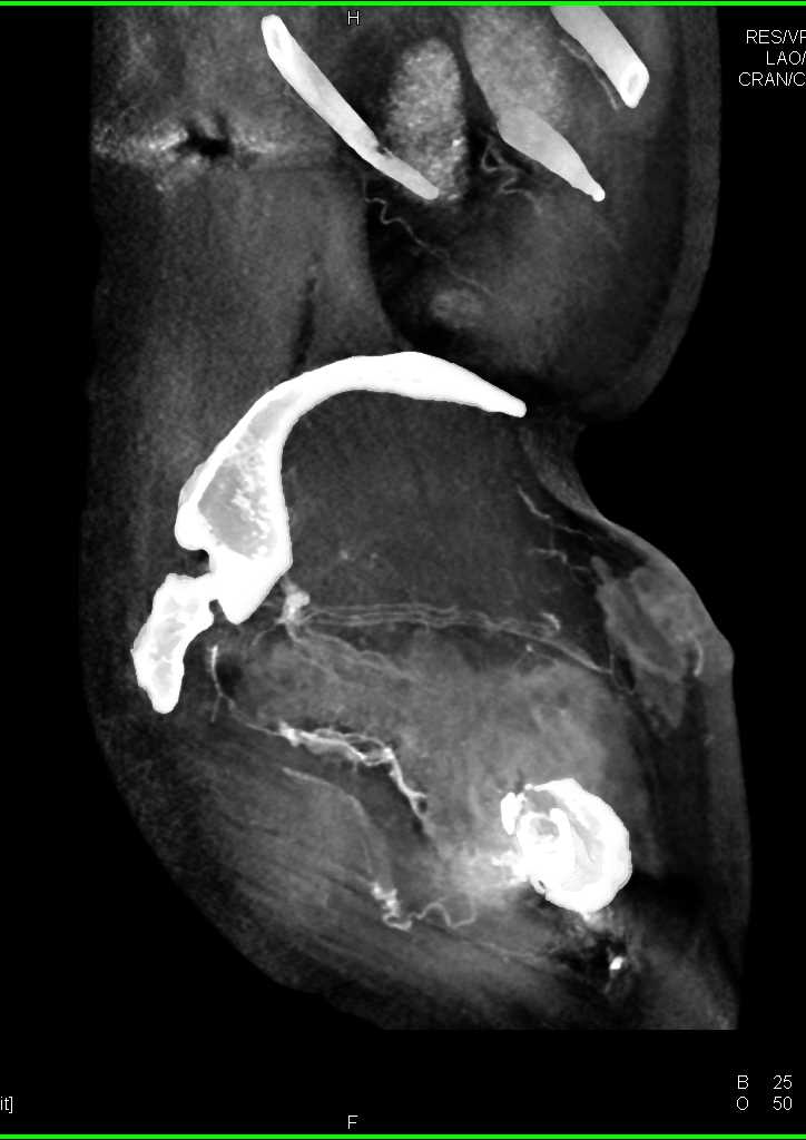 Tumor Infiltration Around the Left Hip into Gluteal Muscles - CTisus CT Scan