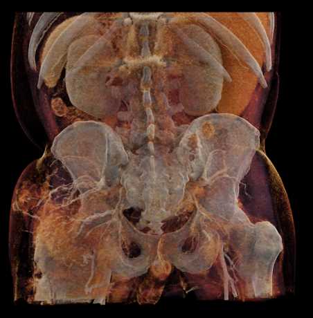 Tumor Infiltration Around the Left Hip into Gluteal Muscles - CTisus CT Scan