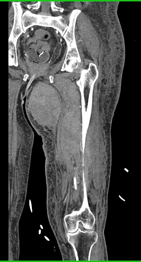 Thigh Hematoma - CTisus CT Scan