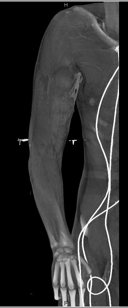 Gunshot Wound (GSW) Shoulder with Brachial Artery Occlusion - CTisus CT Scan