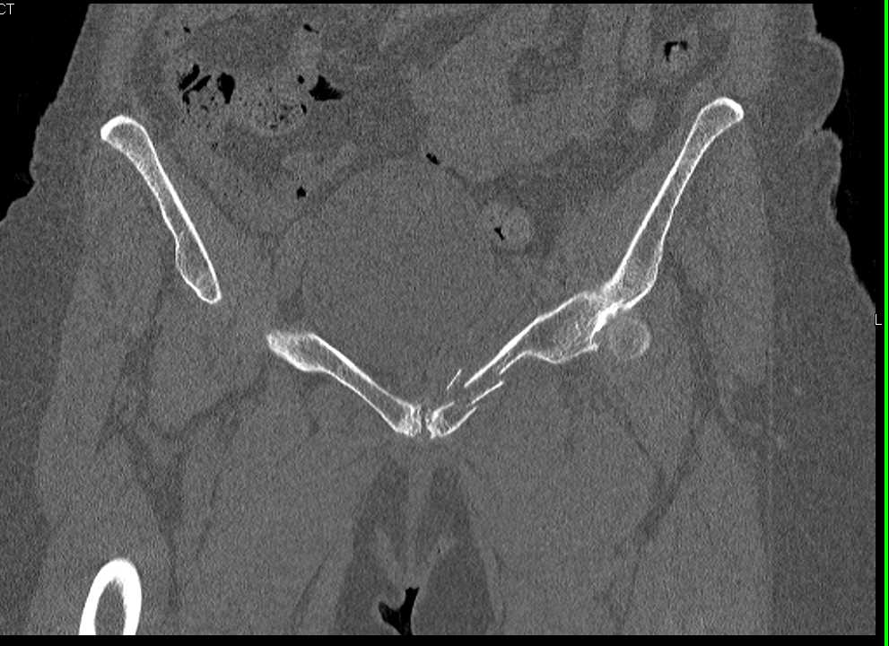 Fracture of Left Pelvic Ring - CTisus CT Scan