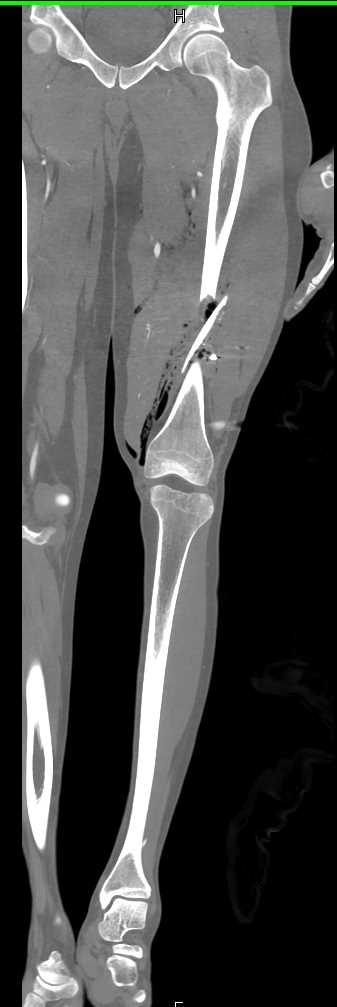 Comminuted Femur Fracture due to GSW - CTisus CT Scan