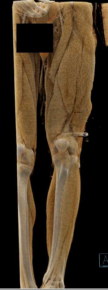 Comminuted Femur Fracture due to GSW - CTisus CT Scan