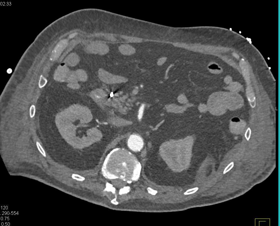 Hematoma Left Flank - CTisus CT Scan