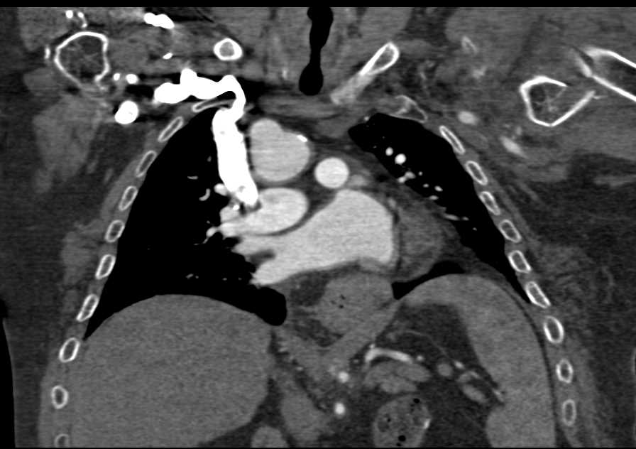 Morquio's Disease - CTisus CT Scan