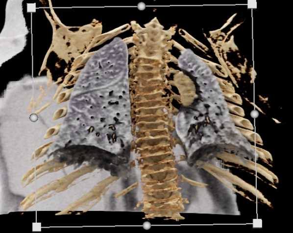 Morquio's Disease - CTisus CT Scan