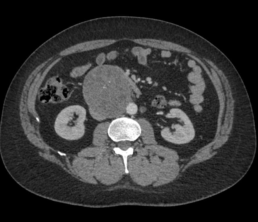 Teratoma Retroperitoneum - CTisus CT Scan