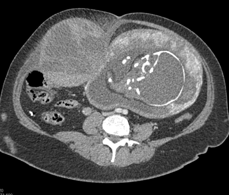 Rectus Sheath Hematoma in a Pregnant Patient - CTisus CT Scan