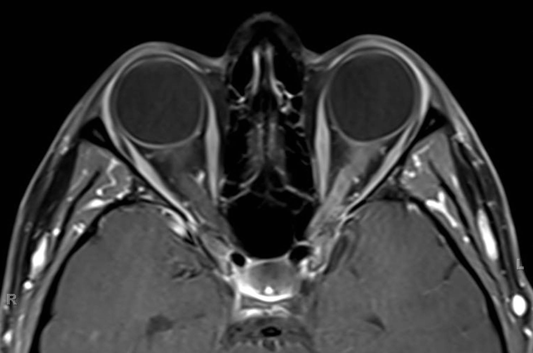 optic-neuritis-neuro-mr-case-studies-ctisus-ct-scanning