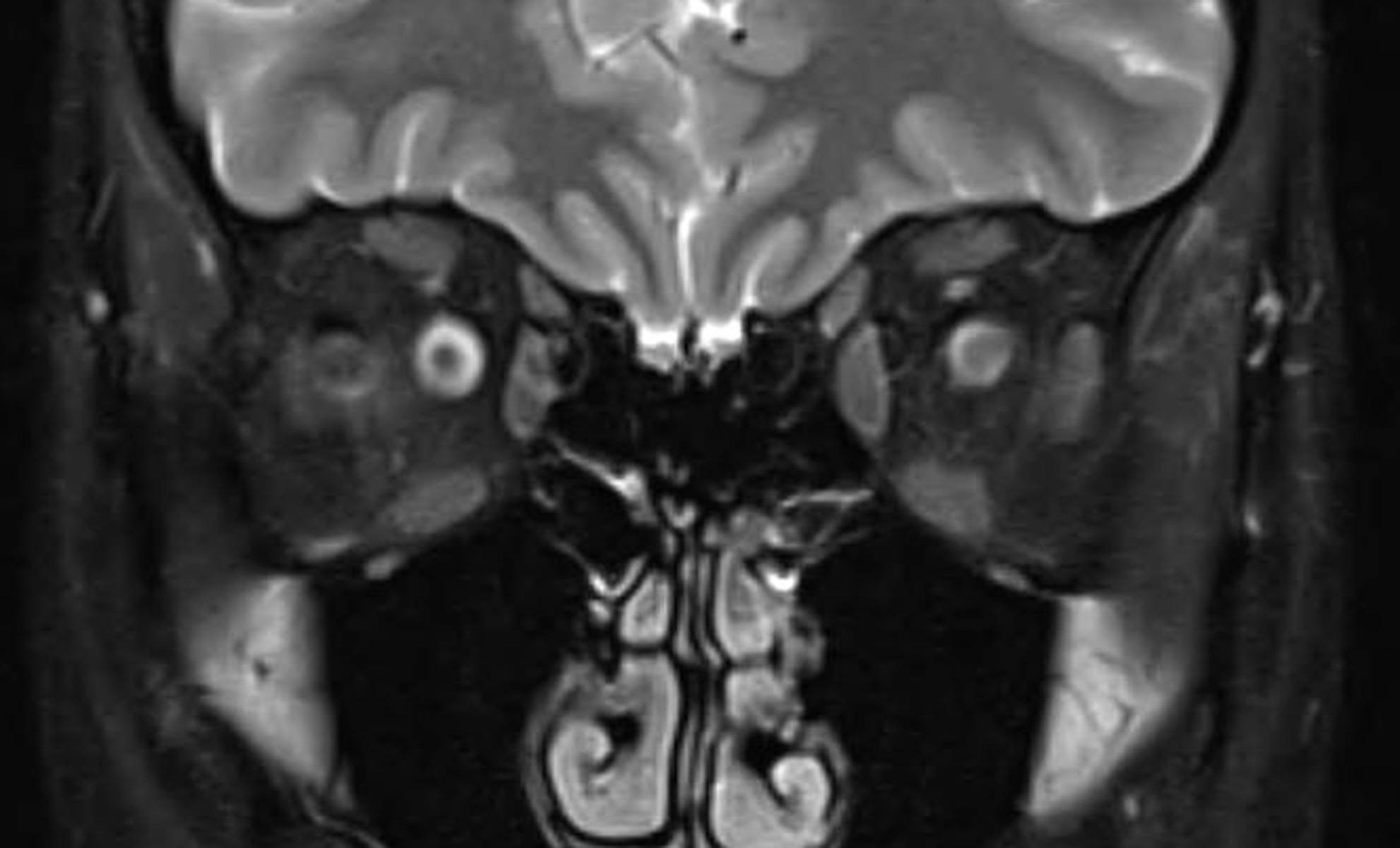 optic-neuritis-neuro-mr-case-studies-ctisus-ct-scanning