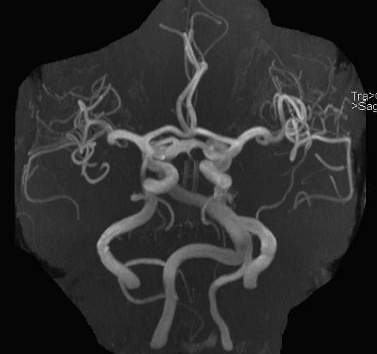 Trigeminal Neuralgia. - CTisus CT Scan