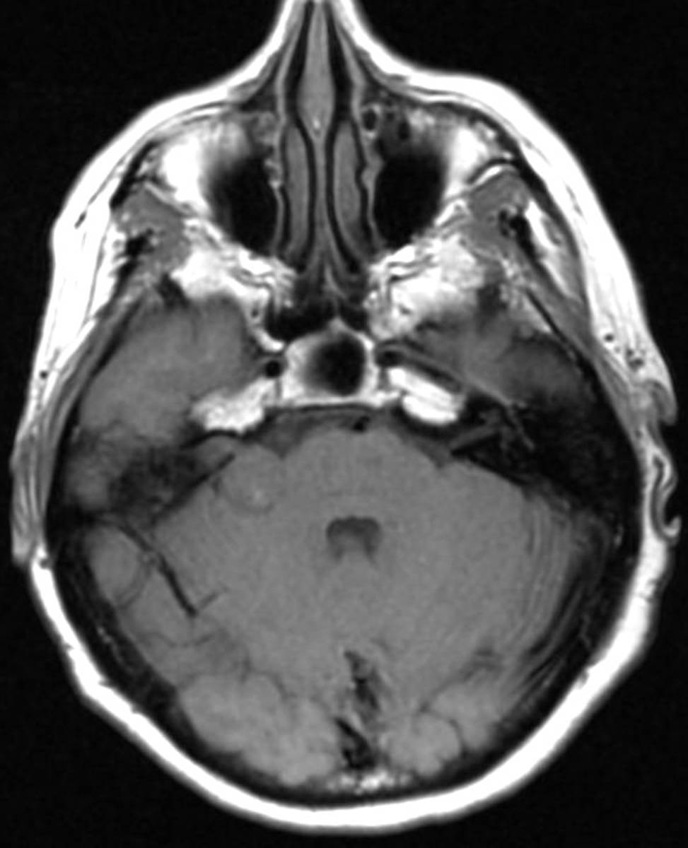 Vestibular Schwannoma. - CTisus CT Scan