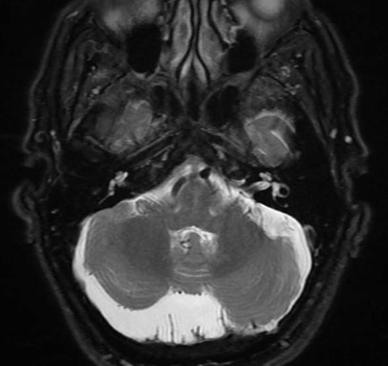 Arachnoid Cyst - CTisus CT Scan