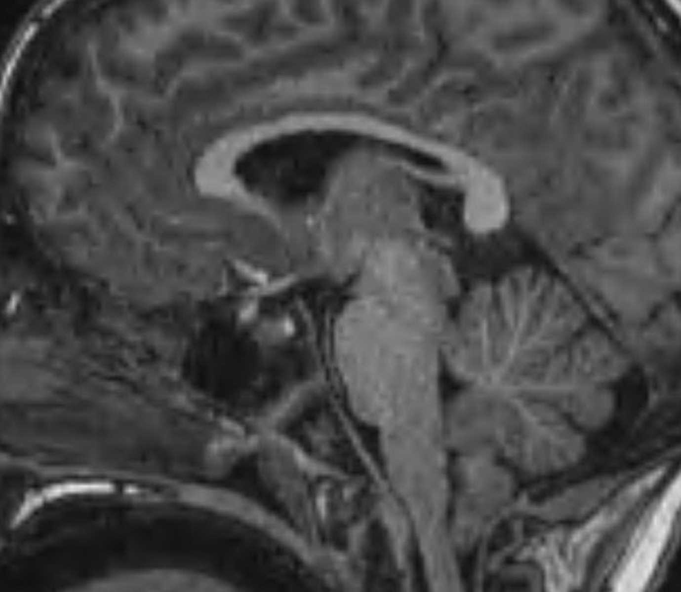 Chiari I Malformation - CTisus CT Scan