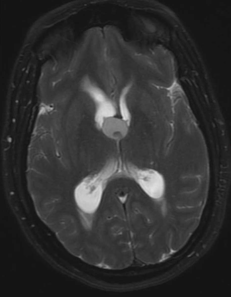 Colloid Cyst - CTisus CT Scan