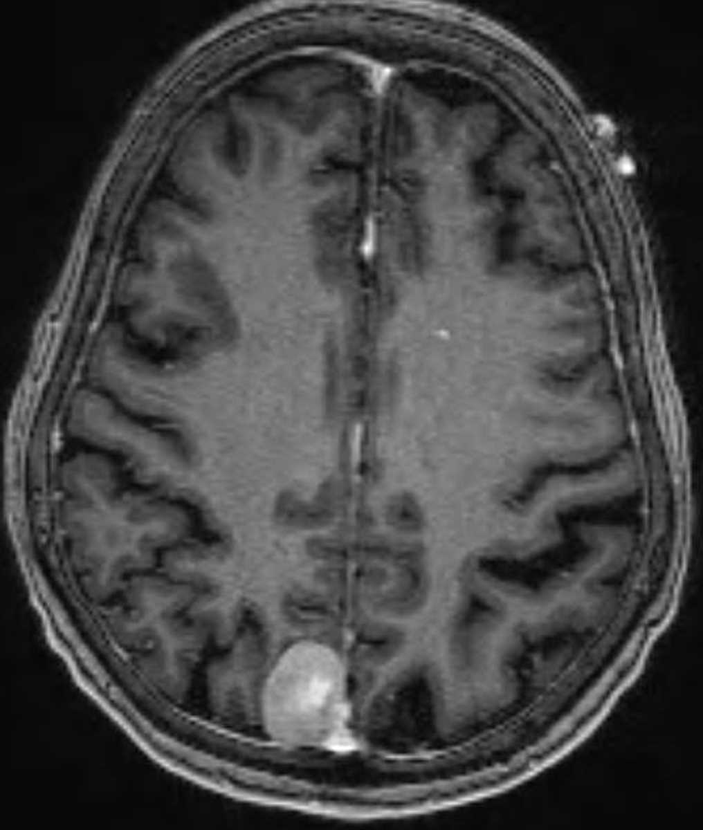 Developmental Venous Anomaly - CTisus CT Scan