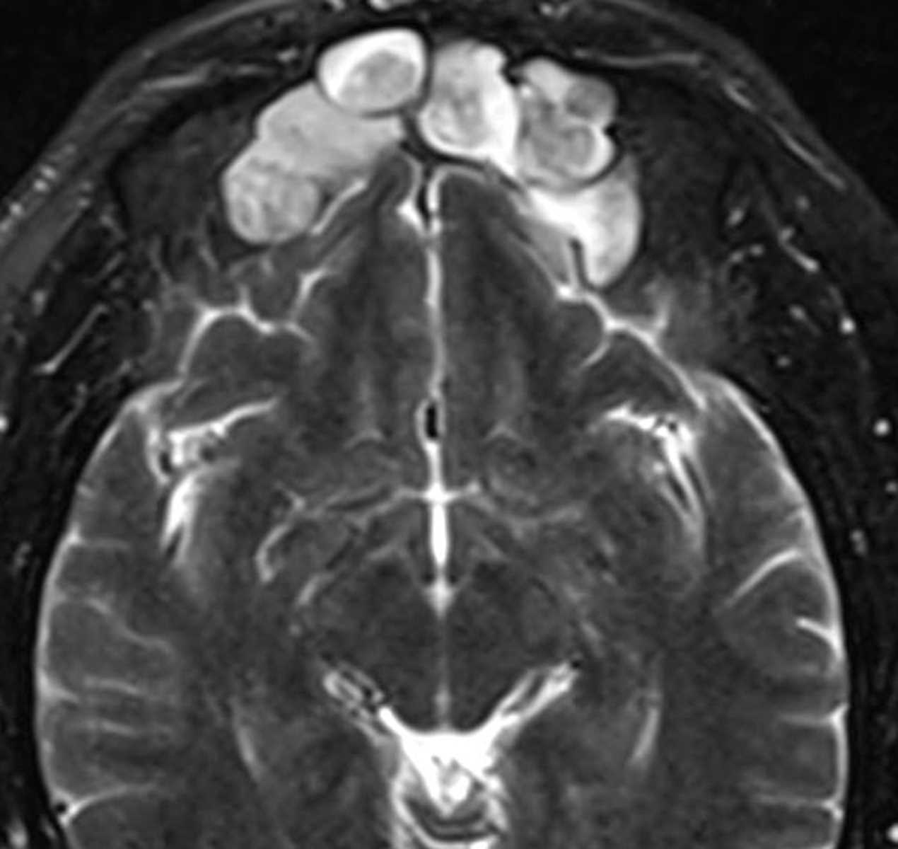 Frontal Mucocele - CTisus CT Scan