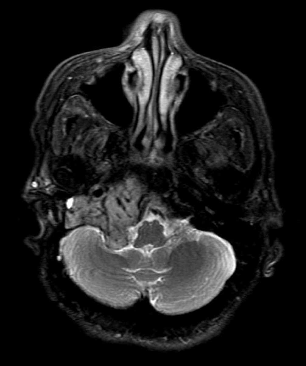 Glomus Jugulare - CTisus CT Scan