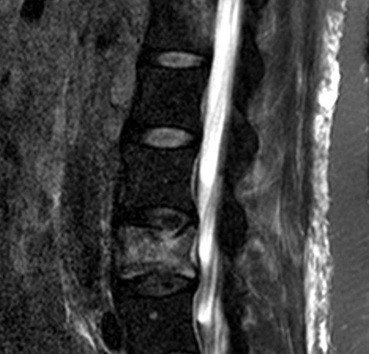 Pathologic Fracture - CTisus CT Scan